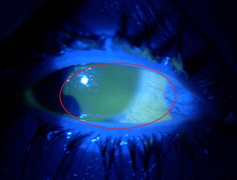 מונת ארכיון המדגימה את הפגיעה בגדולה בשטח העין בקרנית ובלחמית כתוצאה מחשיפה לחומר כימי
