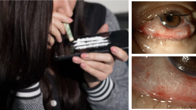 העין התנפחה ונהרסו מחיצות האף